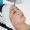 Microdermabrasion