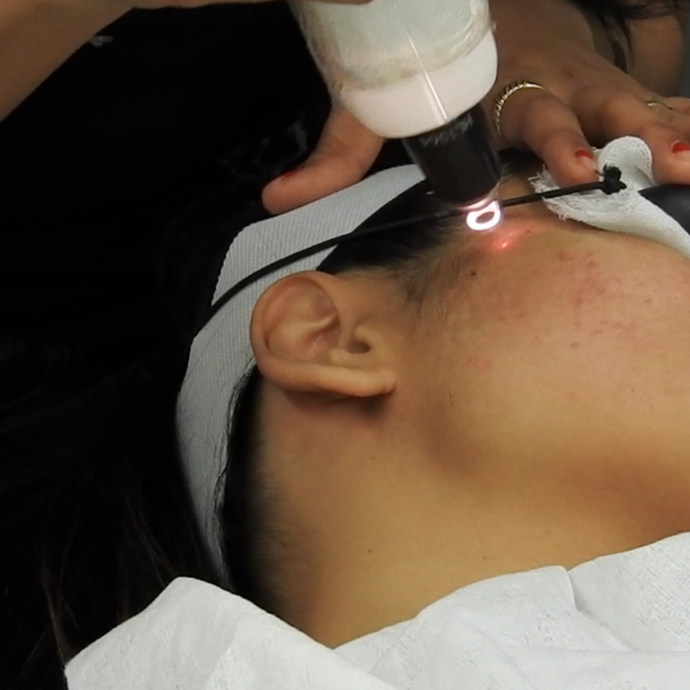 q-switch-laser-treatment
